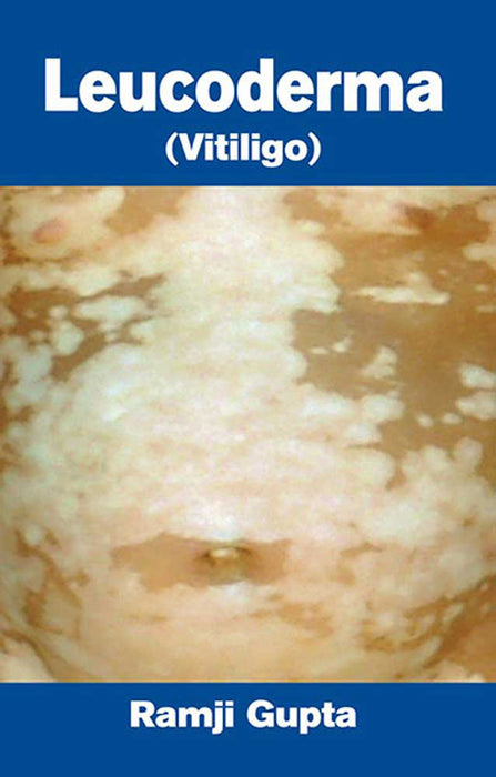 Leucoderma: Vitiligo